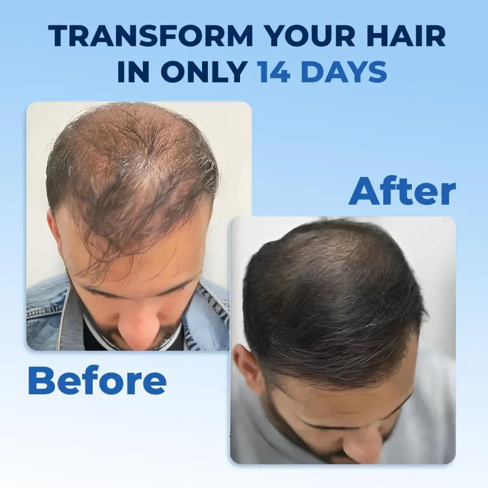 Efgplus hair growth spray – 50ml (pack of 2)