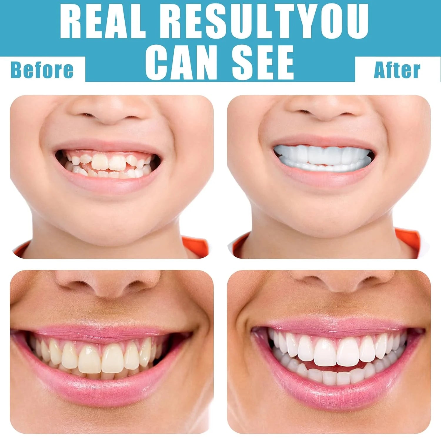 Instant smile cosmetic teeth