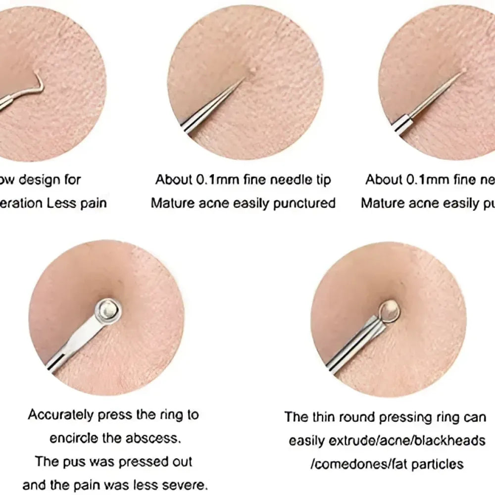 Blackhead remover tool set