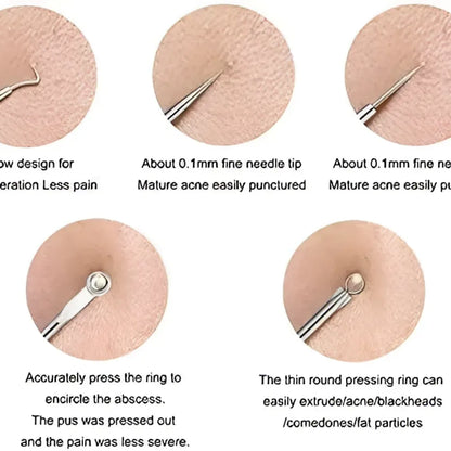 Blackhead remover tool set