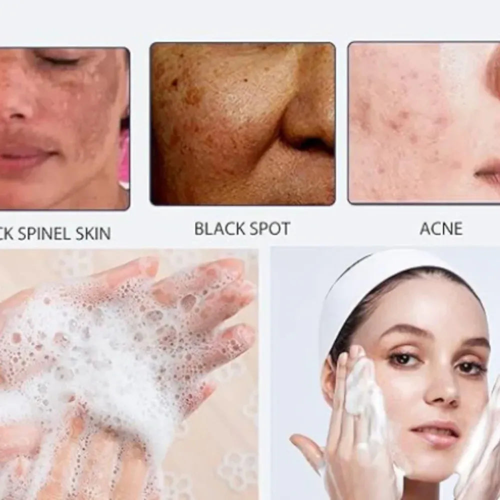 Lucacci acne spot lotion (pack of 2)