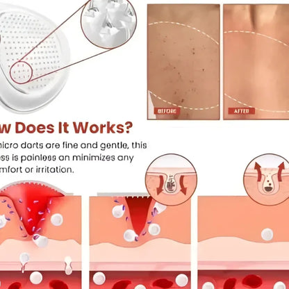 Skin tag remover patches