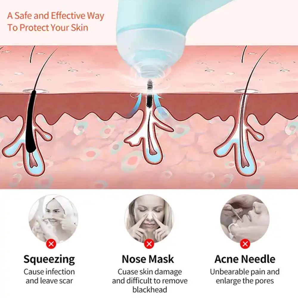 Vacuum blackhead remover - health care